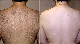 Laser Hair Removal -Back