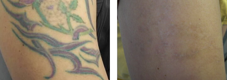 Laser Tattoo Removal – Arm – Before and After
