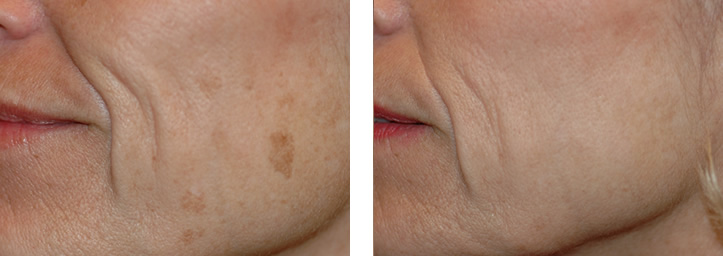 before and after photos of age spot removal