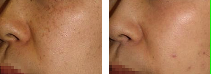 before and after photos of freckle removal