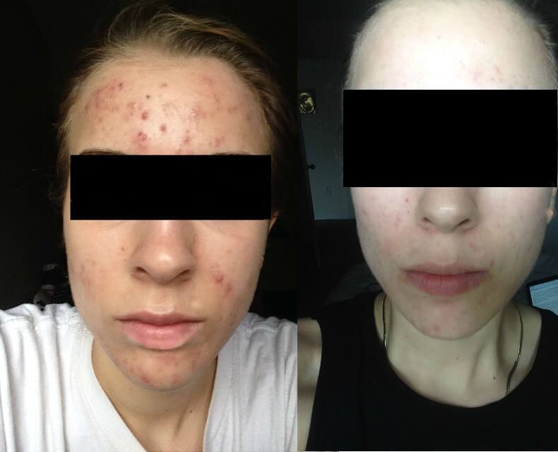 A Woman With Excessive Pimples on the Head