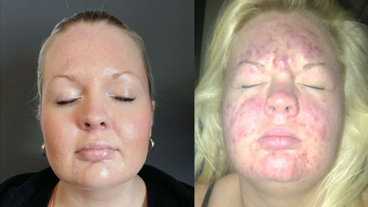 before and after photos of a spectra laser treatment
