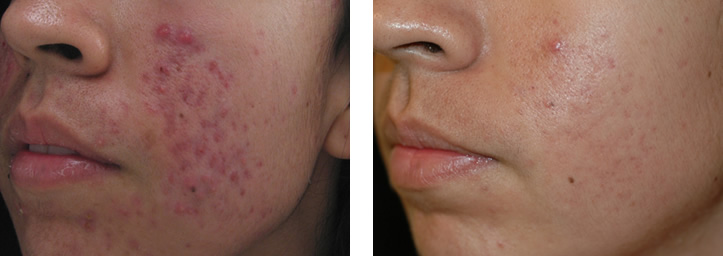 before and after photos of a laser treatment for acne