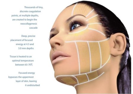 HIFU skin tightening visual explanation