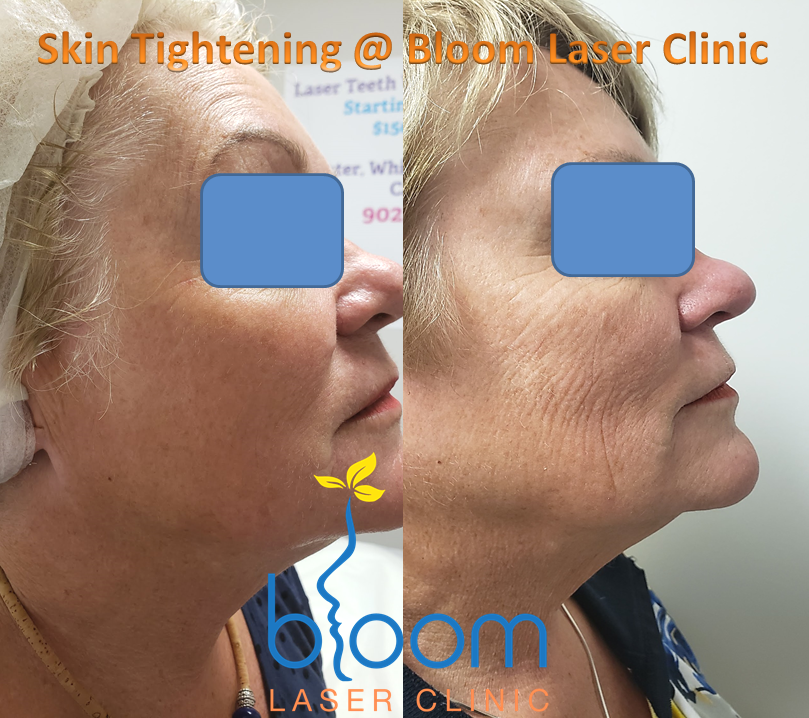 female client getting skin tightening treatment at Bloom Laser Clinic