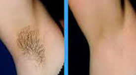 Laser Hair Removal-Under arm