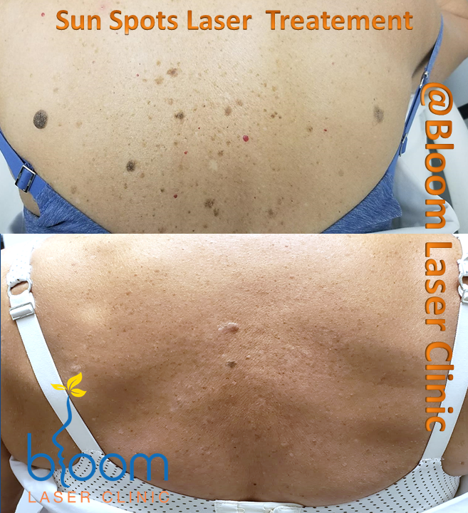 sun spots laser treatment female client