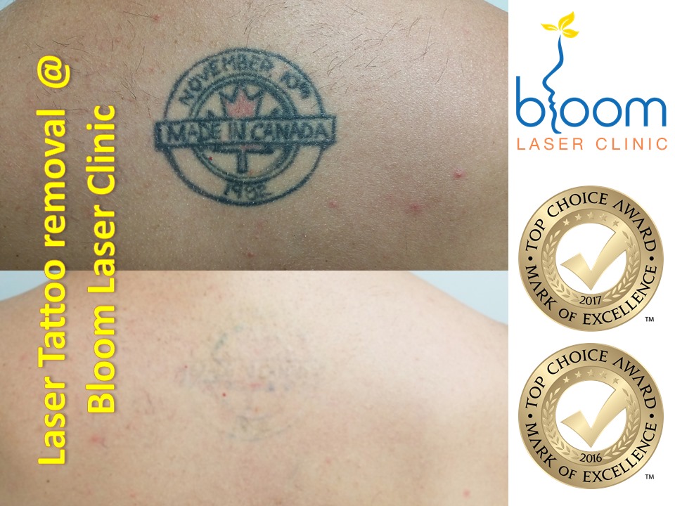 before and after photos of laser tattoo removal
