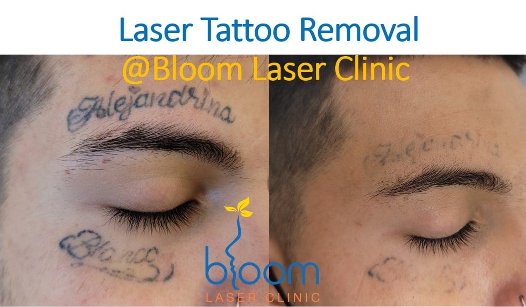laser tattoo removal at Bloom Laser Clinic
