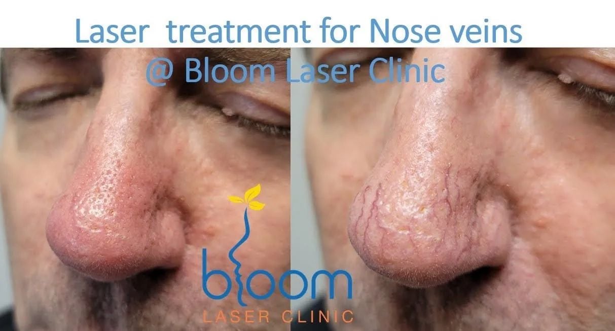 laser treatment for nose veins