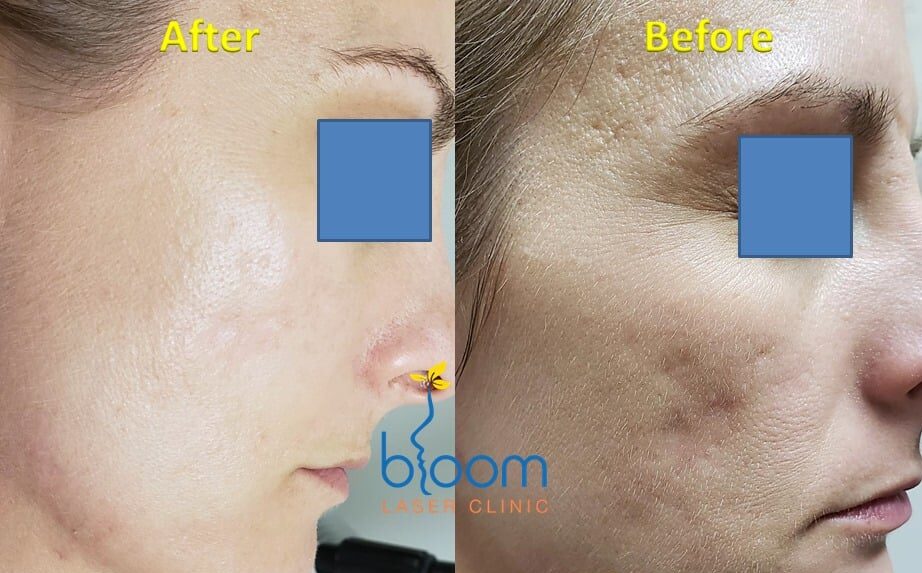 before and after photos of a Pulsed Dye Laser treatment